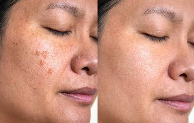 Suero Corrector de Manchas Oscuras