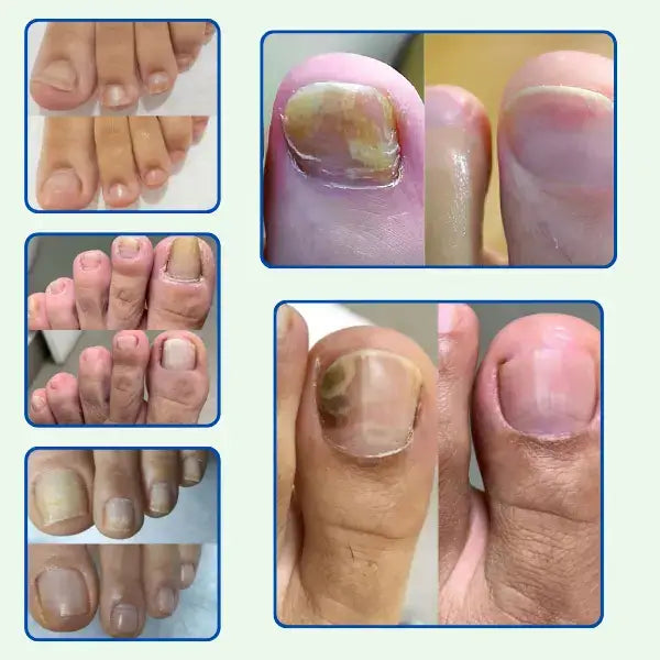TRATAMIENTO ANTI HONGOS 100% NATURAL 7 DÍAS (2x1)