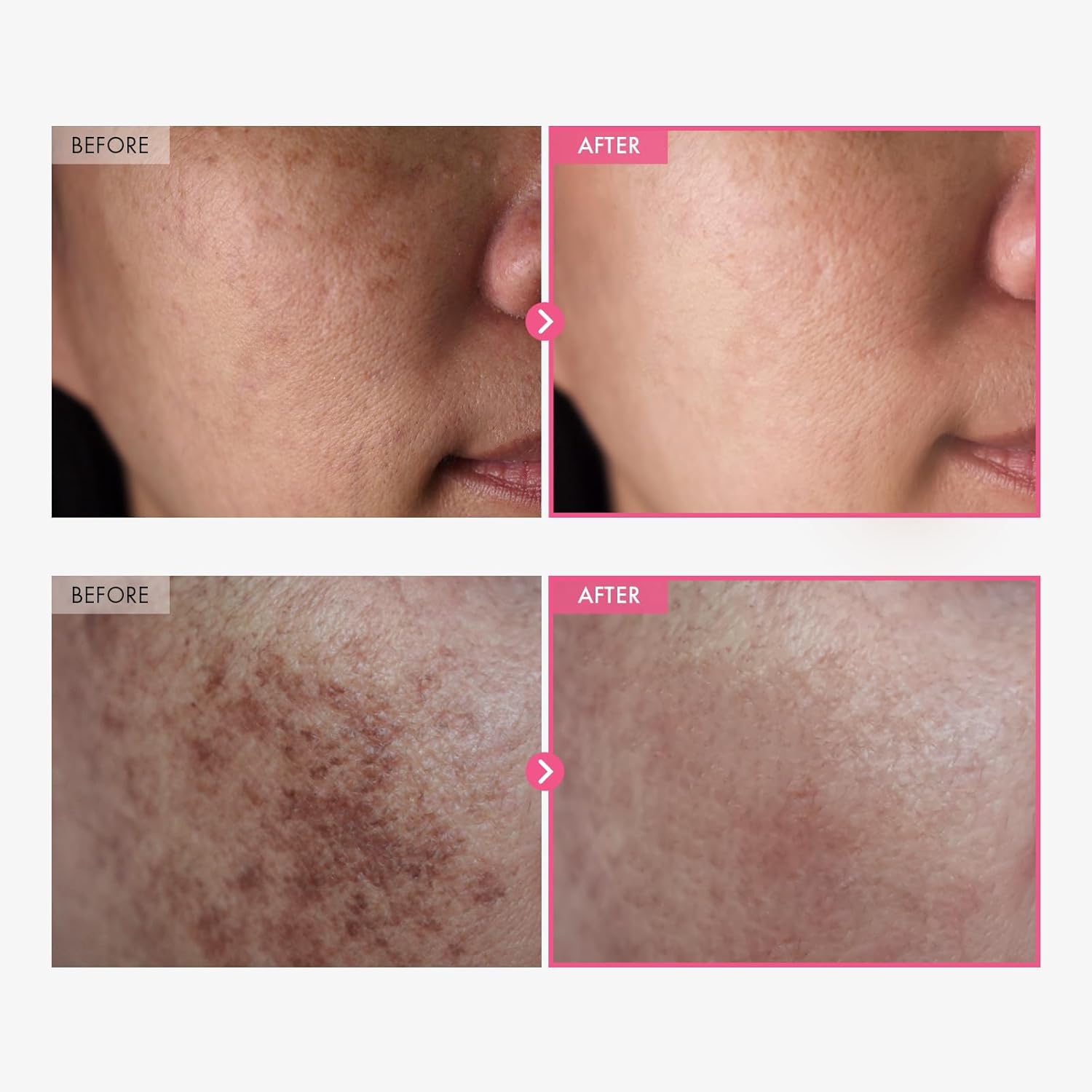 Crema Arbutin 7.0 + TXA 4.0,/ Eficacia Dermatológica