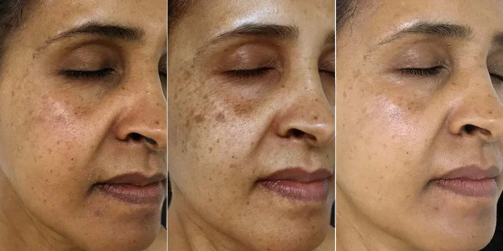 Suero Corrector de Manchas Oscuras